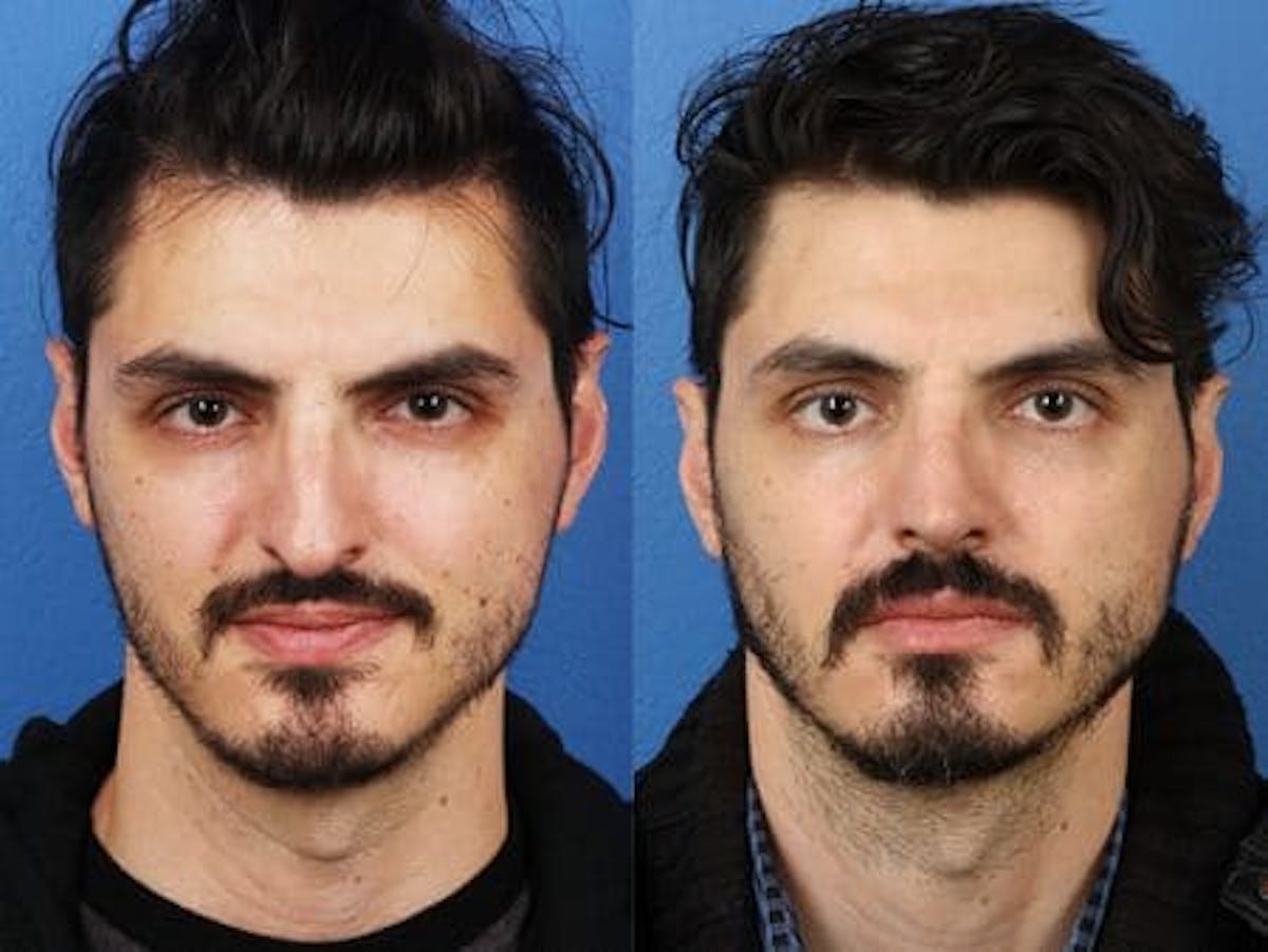 Ethnic Rhinoplasty Before & After Gallery - Patient 37903763 - Image 2