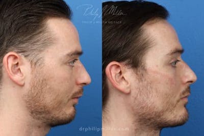 G. I. Jaw/Chin Contouring Before & After Gallery - Patient 37903765 - Image 1
