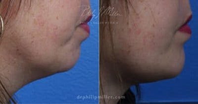 G. I. Jaw/Chin Contouring Before & After Gallery - Patient 37903773 - Image 1