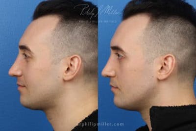 G. I. Jaw/Chin Contouring Before & After Gallery - Patient 37903781 - Image 1