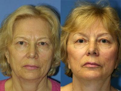 Facelift/NatraLift Before & After Gallery - Patient 37903784 - Image 1