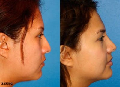 Ethnic Rhinoplasty Before & After Gallery - Patient 37903786 - Image 1