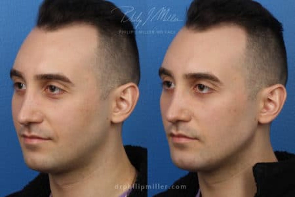 G. I. Jaw/Chin Contouring Before & After Gallery - Patient 37903781 - Image 2