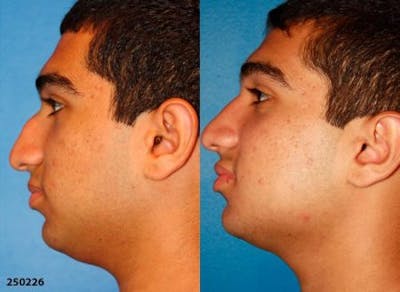 Ethnic Rhinoplasty Before & After Gallery - Patient 37903792 - Image 1