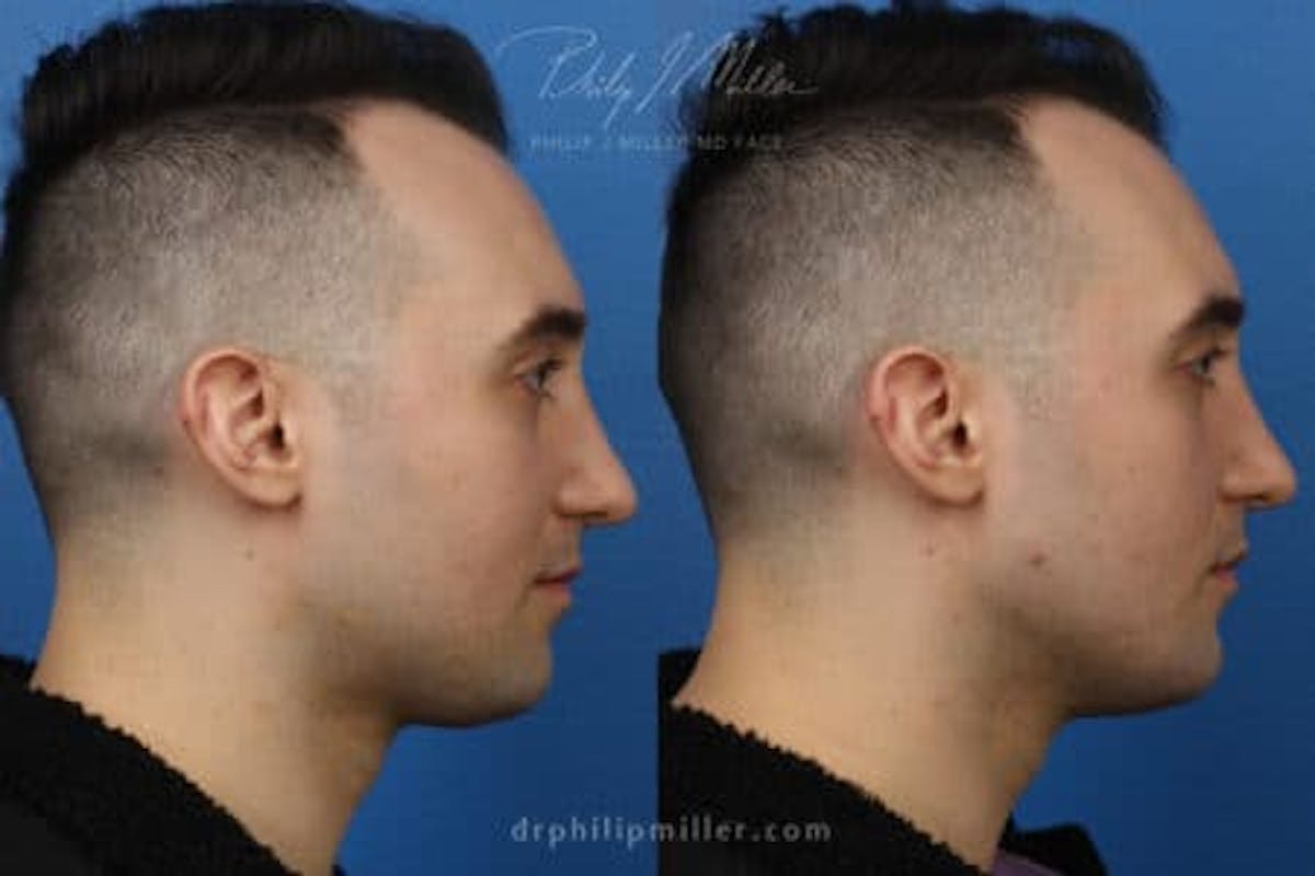 G. I. Jaw/Chin Contouring Before & After Gallery - Patient 37903781 - Image 3