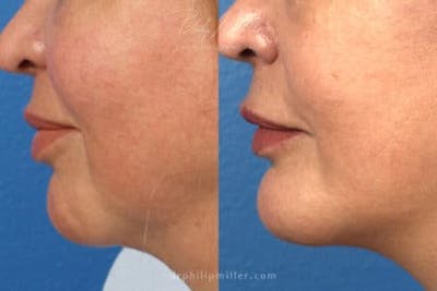 G. I. Jaw/Chin Contouring Before & After Gallery - Patient 37903801 - Image 1