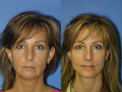 Facelift/NatraLift Before & After Gallery - Patient 37903806 - Image 1
