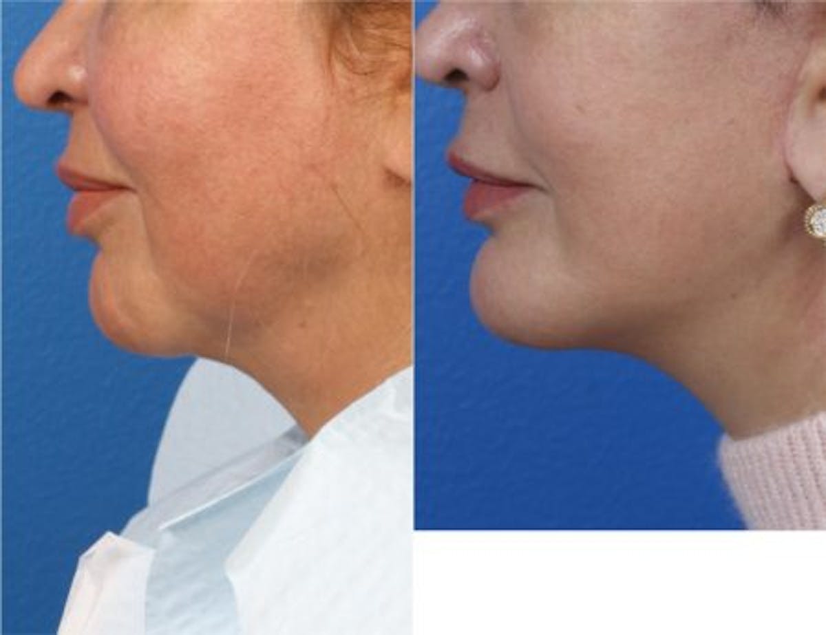 G. I. Jaw/Chin Contouring Before & After Gallery - Patient 37903801 - Image 2
