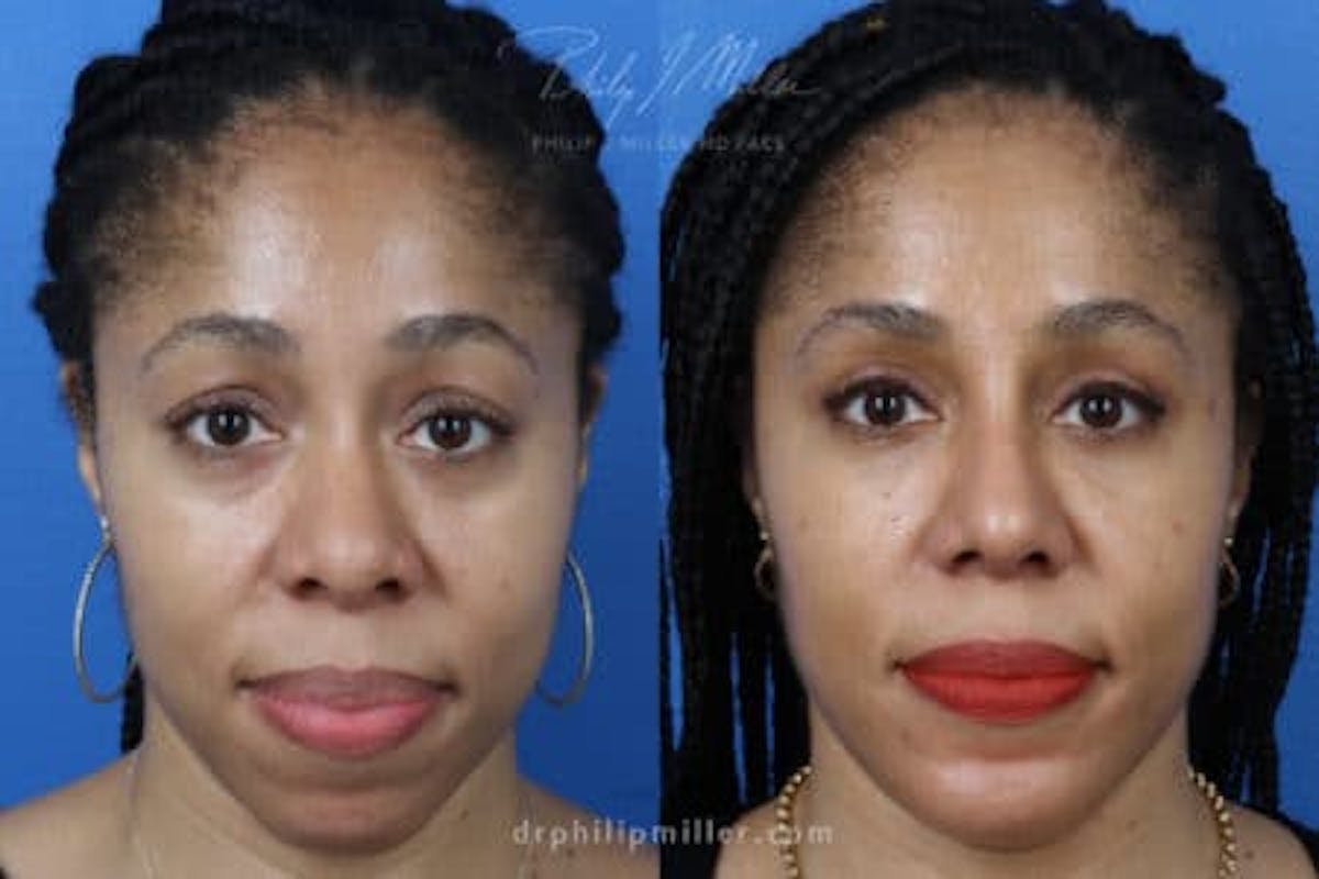 G. I. Jaw/Chin Contouring Before & After Gallery - Patient 37903815 - Image 1
