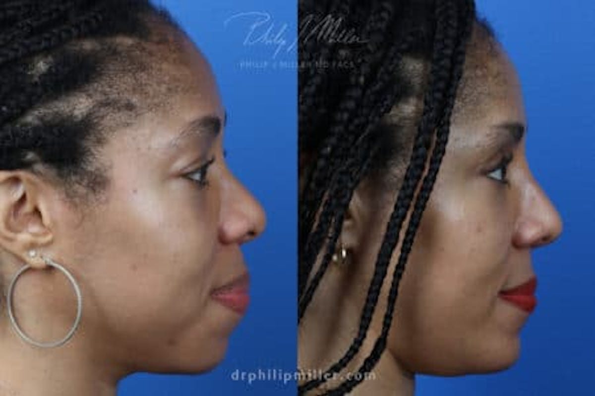 G. I. Jaw/Chin Contouring Before & After Gallery - Patient 37903815 - Image 3