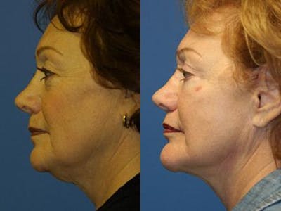 Facelift/NatraLift Before & After Gallery - Patient 37903834 - Image 1