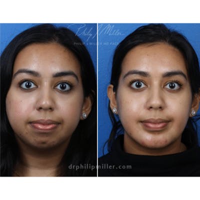 G. I. Jaw/Chin Contouring Before & After Gallery - Patient 37903840 - Image 1