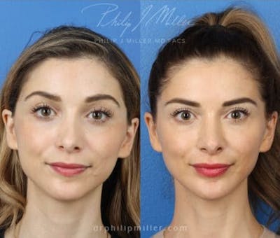 G. I. Jaw/Chin Contouring Before & After Gallery - Patient 37903849 - Image 1