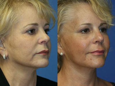 Facelift/NatraLift Before & After Gallery - Patient 37903859 - Image 1