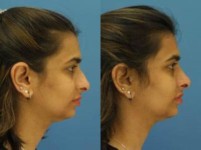 Ethnic Rhinoplasty Before & After Gallery - Patient 37903862 - Image 1