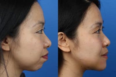 G. I. Jaw/Chin Contouring Before & After Gallery - Patient 37903867 - Image 1