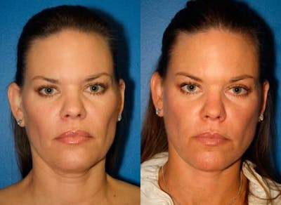 Facelift/NatraLift Before & After Gallery - Patient 37903869 - Image 1