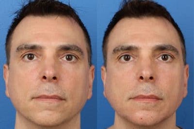 G. I. Jaw/Chin Contouring Before & After Gallery - Patient 37903874 - Image 1