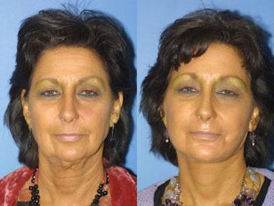 Facelift/NatraLift Before & After Gallery - Patient 37903886 - Image 1