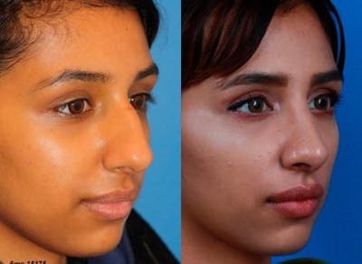 Ethnic Rhinoplasty Before & After Gallery - Patient 37903897 - Image 1