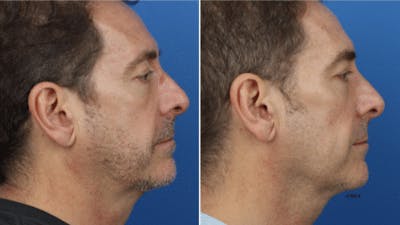 G. I. Jaw/Chin Contouring Before & After Gallery - Patient 37903900 - Image 1
