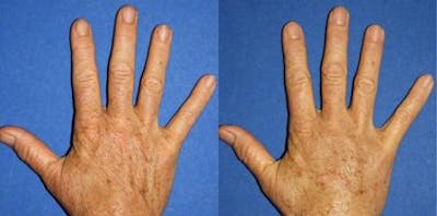 Hand Rejuvenation Before & After Gallery - Patient 37903899 - Image 1