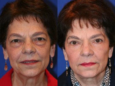 Facelift/NatraLift Before & After Gallery - Patient 37903904 - Image 1
