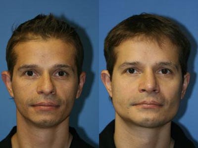 G. I. Jaw/Chin Contouring Before & After Gallery - Patient 37903918 - Image 1