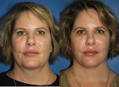 Facelift/NatraLift Before & After Gallery - Patient 37903921 - Image 1