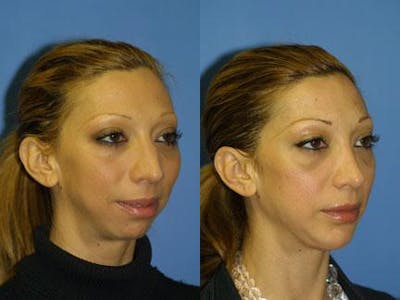 G. I. Jaw/Chin Contouring Before & After Gallery - Patient 37903950 - Image 1