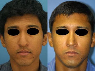 Ethnic Rhinoplasty Before & After Gallery - Patient 37903954 - Image 1