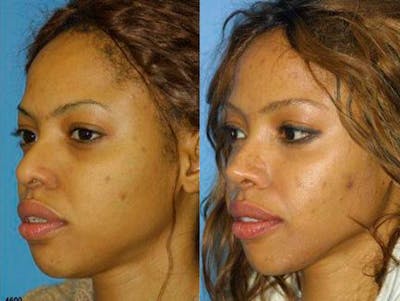 Ethnic Rhinoplasty Before & After Gallery - Patient 37903976 - Image 1