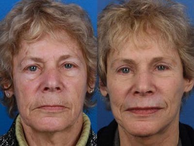 Facelift/NatraLift Before & After Gallery - Patient 37903973 - Image 1