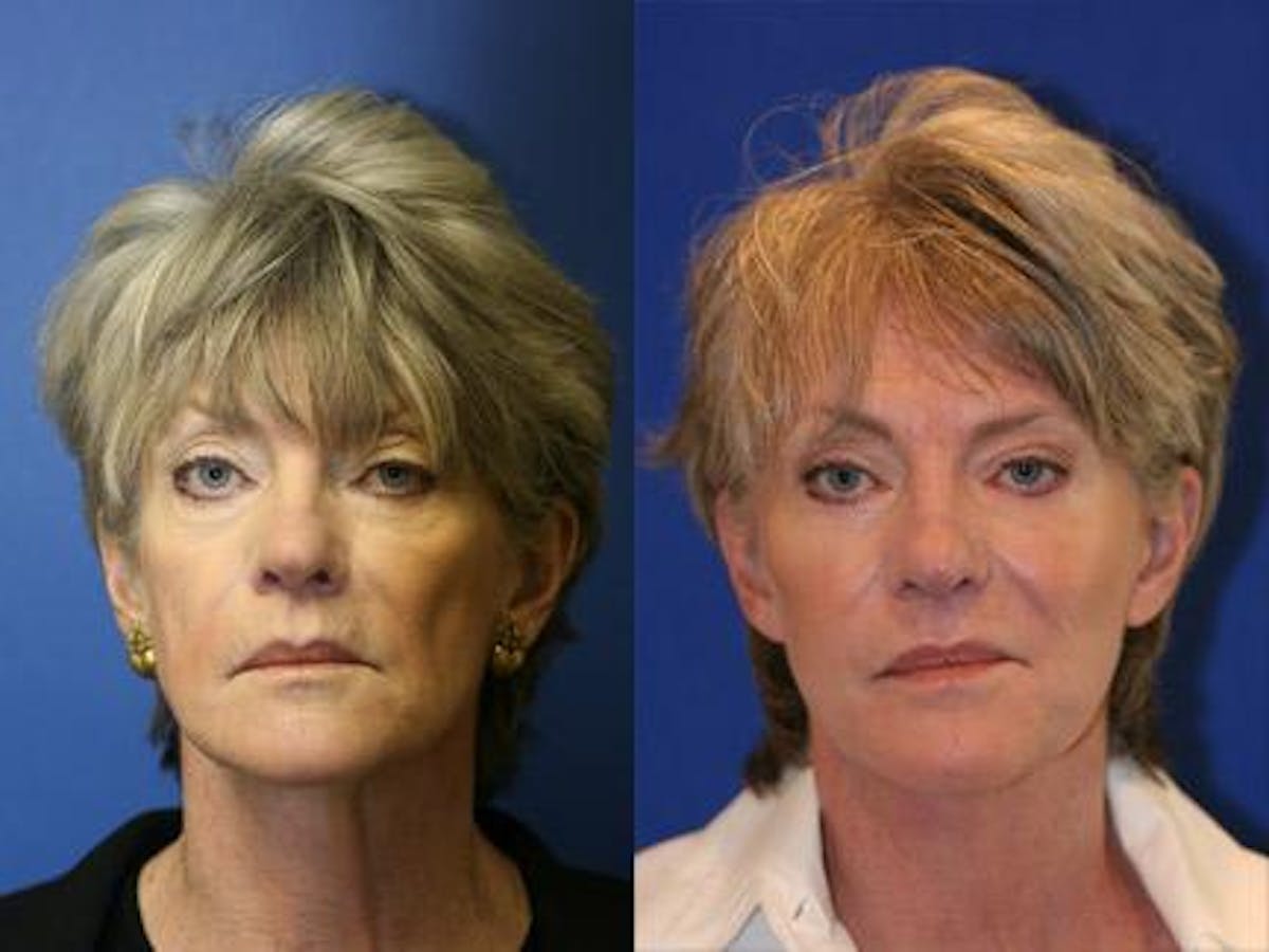 Laser Before & After Gallery - Patient 37903979 - Image 1