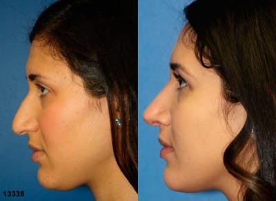 Ethnic Rhinoplasty Before & After Gallery - Patient 37903991 - Image 1