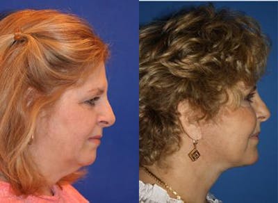 Facelift/NatraLift Before & After Gallery - Patient 37904005 - Image 1