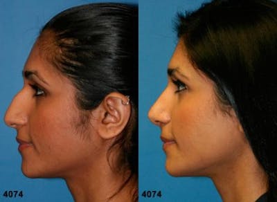 Ethnic Rhinoplasty Before & After Gallery - Patient 37904010 - Image 1