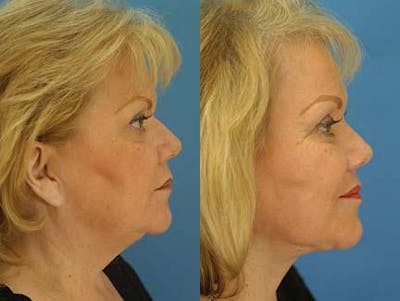 Facelift/NatraLift Before & After Gallery - Patient 37904015 - Image 1
