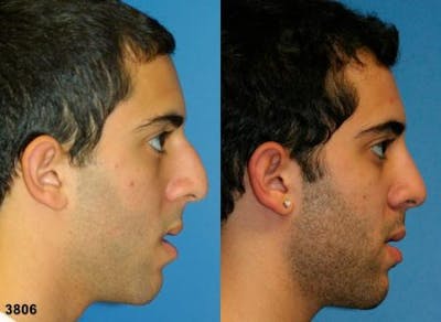 Ethnic Rhinoplasty Before & After Gallery - Patient 37904019 - Image 1