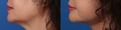 Facelift/NatraLift Before & After Gallery - Patient 37904022 - Image 1