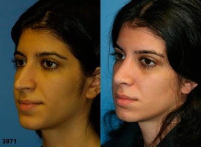Ethnic Rhinoplasty Before & After Gallery - Patient 37904028 - Image 1