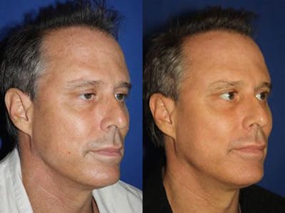 Laser Before & After Gallery - Patient 37904038 - Image 1