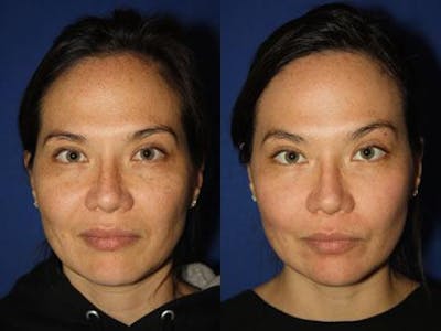 Laser Before & After Gallery - Patient 37904042 - Image 1