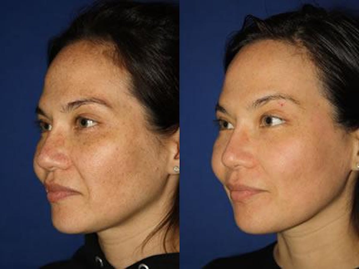 Laser Before & After Gallery - Patient 37904042 - Image 2
