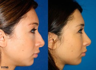 Ethnic Rhinoplasty Before & After Gallery - Patient 37904043 - Image 1