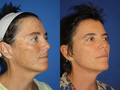 Laser Before & After Gallery - Patient 37904055 - Image 1