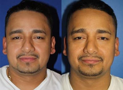 Ethnic Rhinoplasty Before & After Gallery - Patient 37904058 - Image 1
