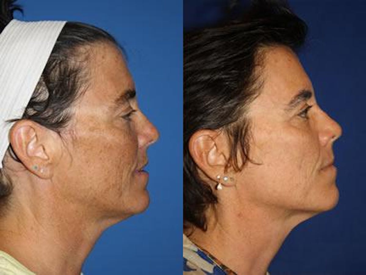 Laser Before & After Gallery - Patient 37904055 - Image 2