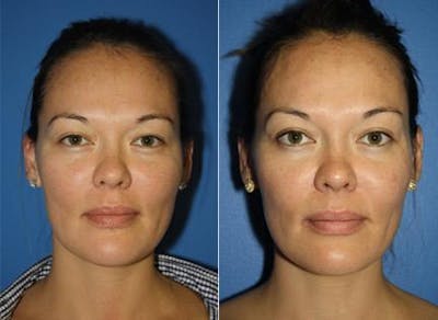 Laser Before & After Gallery - Patient 37904069 - Image 1
