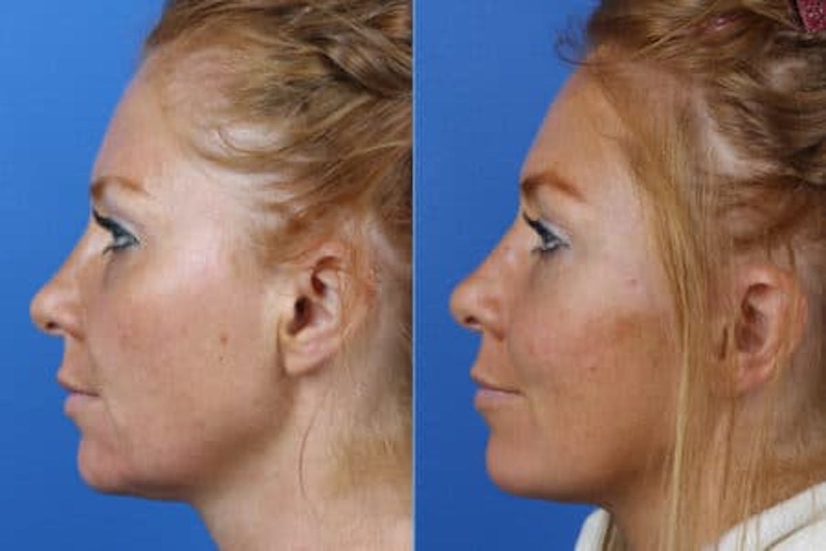 Micro Lift Before & After Gallery - Patient 37904063 - Image 2